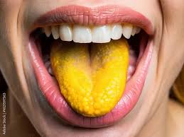 Image result for yellow tongue infection