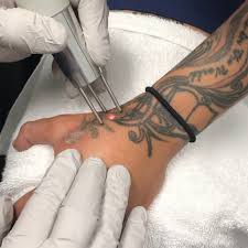 No matter the skin type, laser tattoo removal can leave a trace. 5 Things You Should Know About Tattoo Removal Tattoo Cares