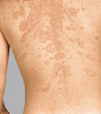 Braune Flecken Apotheken Umschau