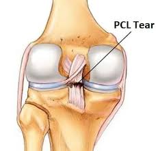 Pcl Injury Symptoms Diagnosis Treatment Knee Pain