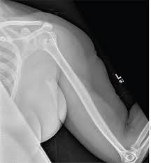Left Arm Pain Numbness And Weakness Clinician Reviews