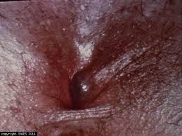 Image result for Hemorrhoid