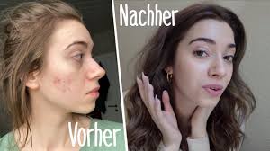 Ich habe die Ursache für meine Pickel gefunden..