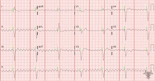 Image result for Atrial Flutter