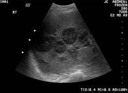 Ultrasounds are not useful for treatment monitoring. Can Ultrasound Detect Cancer New Health Advisor