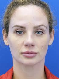 Infralobular Fullness 6804