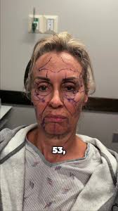 Comprehensive Facial Rejuvenation for Ageless Beauty