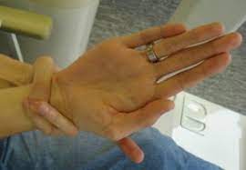 Marfan S Syndrome Bindevevssykdommer Nobindevevssykdommer No