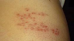 Image result for shingles