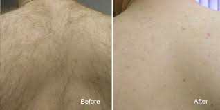 How does laser hair removal work? Surrey Laser Hair Removal Delta Langley Hair Removal Skin Clinic