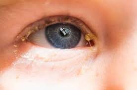 Verklebte Augen Was Verursacht Gelben Schleim Im Auge