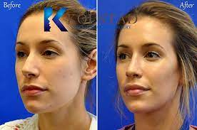 In order to reduce the amount of bruising and swelling at the injection site, dr. Cheek Fillers Smile Line Fillers Results Dr Kolstad San Diego Facial Plastic Surgeon