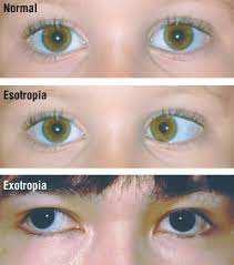 Crossed Eyes Strabismus Harvard Health