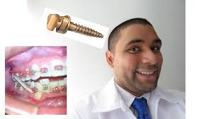 Mira como se Coloca un Mini tornillo para mover dientes de abajo