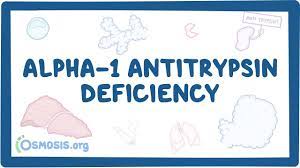Early symptoms of lung disease are wheezing and fatigue. Alpha 1 Antitrypsin Deficiency Causes Symptoms Diagnosis Treatment Pathology Youtube