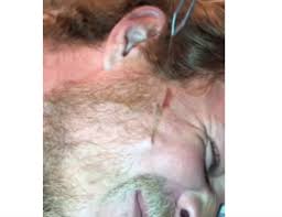 Longest hair on a teenager! Guinness World Record Longest Ingrown Hair New Pimple Popping Videos