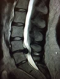 Bandscheibenvorfall Symptome Therapie Operation