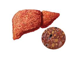 سیروز کبدی | علائم سیروز کبدی | درمان سیروز کبدی - دکتر رکسانا عباسی