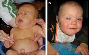 Beckwith–Wiedemann syndrome