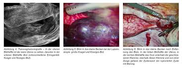 Adenomyose ist eine spezielle unterform von endometriose und wird oftmals nicht erkannt, da die so kann durch eine adenomyose, bei der die muskelschicht der gebärmutter von endometriose. Bayerisches Arzteblatt
