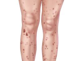 Image result for syphilis