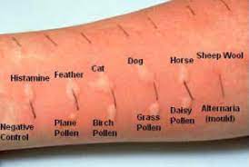 Aashwas Skin Prick Test In Kolkata With Best Facility And Very Low Price