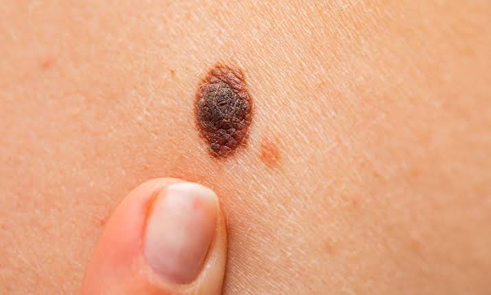 Itchy Moles: What Do They Mean & Are They Harmful? | Affiliated Dermatology