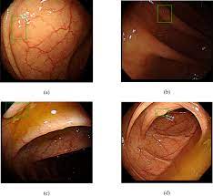 This represents an additional 3.5 million adults screened for colorectal cancer. Real Time Detection Of Colon Polyps During Colonoscopy Using Deep Learning Systematic Validation With Four Independent Datasets Scientific Reports