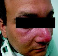 The topical group on shock compression of condensed matter (shock or sccm) is a unit of the american physical society (aps). Cutaneous Manifestations Of Infectious Diseases Springerlink