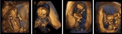 Es ist eine untersuchung am ende des ersten drittels der schwangerschaft. Erst Trimester Screening Nackentransparenz Messung Nt Messung Nt Screening Praxis Fur Pranataldiagnostik In Cottbus
