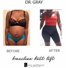 At mia aesthetics we provide the highest quality plastic surgery, all at affordable prices. Mia Aesthetics An Amazing Transformation By Dr Gray Bbl Drgray Miaaestheticsmiami Beforeandafter Facebook