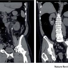 Pdf An Overview Of Kidney Stone Imaging Techniques