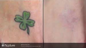 Maybe you would like to learn more about one of these? Laser Tattoo Removal Virginia Beach David H Mcdaniel Md Laser Center And Medical Spadavid H Mcdaniel Md Laser Center And Medical Spa