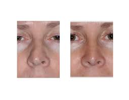 A commonly used procedure is to perform a cartilage graft. Technical Strategies Cartilage Spreader Grafts In Primary Rhinoplasty Explore Plastic Surgery