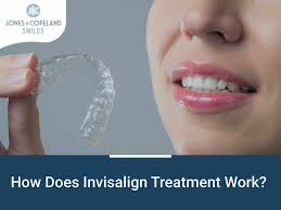 What results is a straight smile. How Does Invisalign Work Better Than Braces