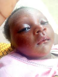 Can I use calamine lotion daily for my baby 🤔