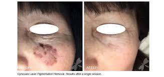Though ayurveda, or ayurvedic medicine, was documented in the sacred historical texts known as the vedas many centuries ago, ayurveda has evolved over the years and is now integrated with other traditional practices, including yoga. Laser Pigmentation Removal The Laser And Skin Clinic