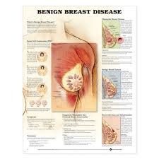 benign breast disease anatomical chart health health