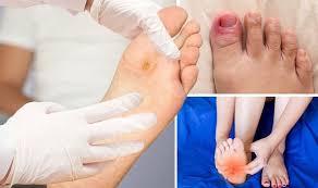 We did not find results for: Diabetes Type 2 Symptoms Include Foot Ulcers And Infections Express Co Uk