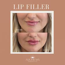 Customizable Lip Filler ✨ One product doesn't fit all! Here at Alchemy  Aesthetics Co. we customize to your lips needs. At each treatment we may  use more than one type of HA