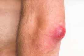 We did not find results for: Home Remedies For Boils