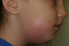 Oral Manifestations of Systemic Diseases and their Treatments