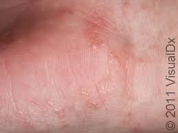 Image result for scabies human bites