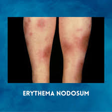 Image result for erythema nodosum
