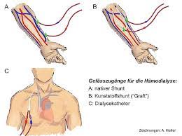 Informationen Zu Nierenerkrankungen Und Deren Behandlung Spital Thurgau Ag
