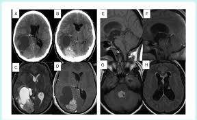 Pleomorphic xanthoastrocytoma is a rare variant of cerebral glioma. Pleomorphic Xanthoastrocytoma A D Pre And Post Contrast Ct A B Download Scientific Diagram
