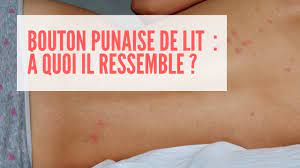 Check spelling or type a new query. Bouton Punaise De Lit A Quoi Il Ressemble Bouton Puce De Lit Youtube