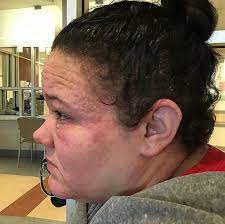 Mum Terrified To Shower After Horrific Hair Dye Reactions Left Her Swollen Scabbed And Scarred Which Docs Incorrectly Confused For Herpes Storytrender