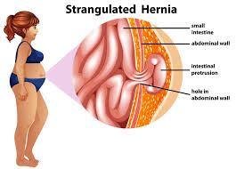 Image result for stomach hernia symptoms