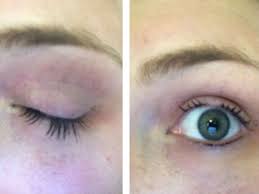 It occurs when the glands got irritated, causing redness, itching, burning, and sometimes can lead to eyelashes falling out, especially if your skin around your eyelash line gets dry. Women Claim Covergirl Mascara Made Eyelashes Fall Out